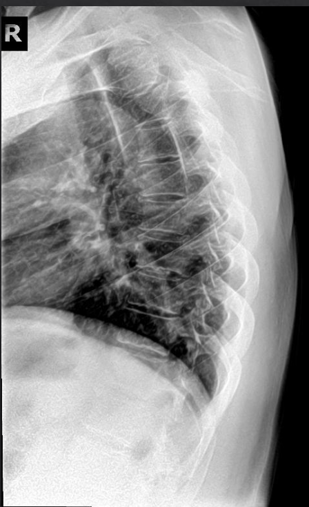 <p>Is this film of diagnostic quality (Lateral Thoracic)</p>