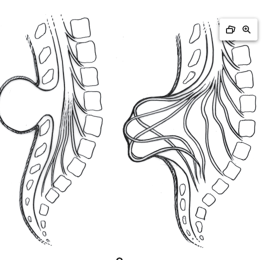 <p>Typically, an open defect</p><p>May also be referred to as spina bifida cystica</p><p>Mass is referred to as a meningocele or meningomyelocele (myelomeningocele) depending upon contents</p>