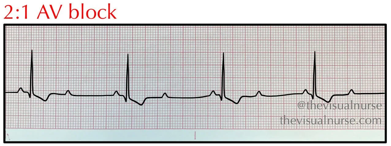 <p>Rate: depends on the underlying rhythm </p><p>Regularity: regular </p>