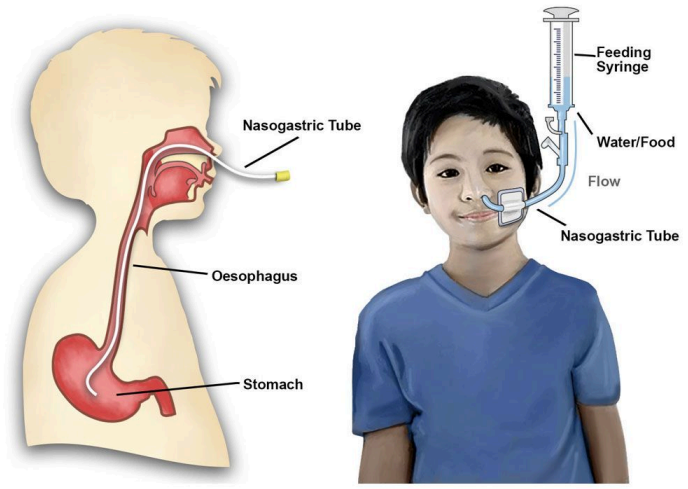 <p><span><span>For feeding, gastric decompression and keeping the stomach empty after surgery</span></span></p>