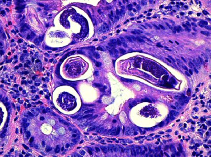 <p>Patient avec diarrhée </p><p>1) diagnostic </p><p>2) site préférentiel</p><p>3) histologie </p>