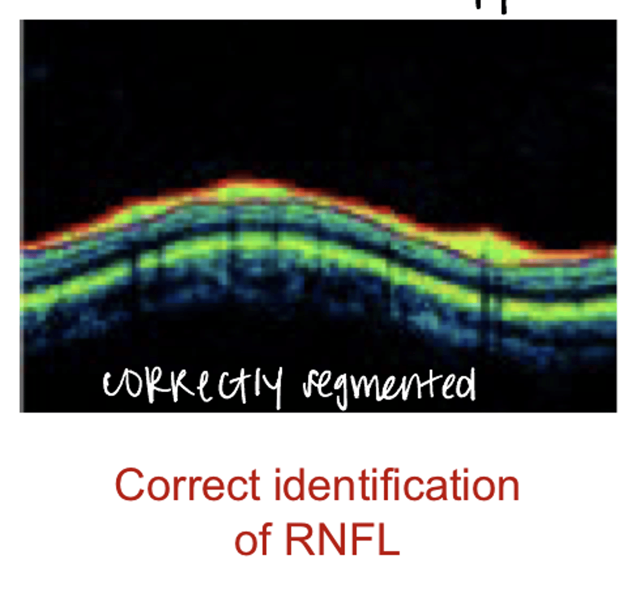 <p>Correct Identification of the RNFL (Pic)</p>