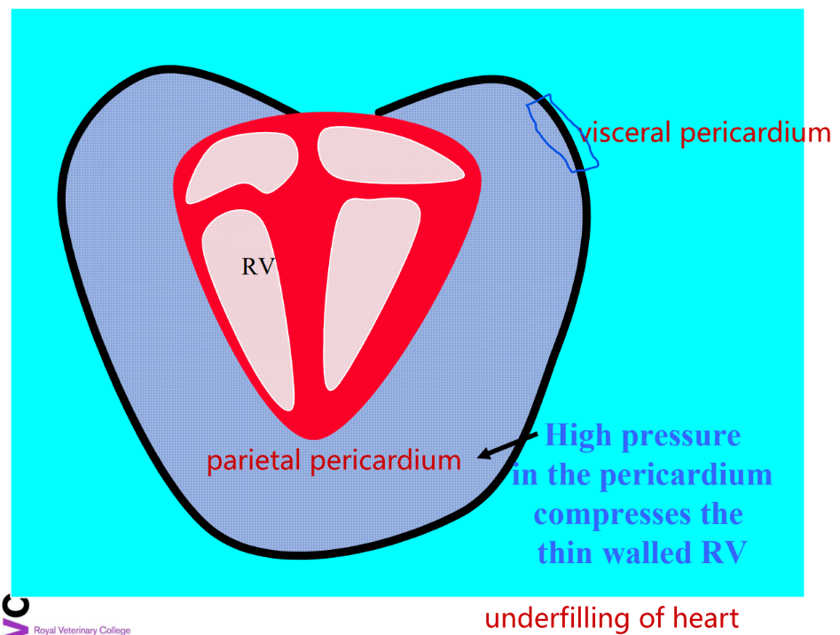 <p>RSCHF- right ventricle has thinner wall than left</p><p>underfilling of heart</p>