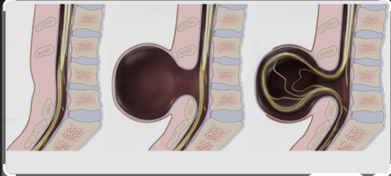<p>Label the spina bifida spectrum from left to right </p>