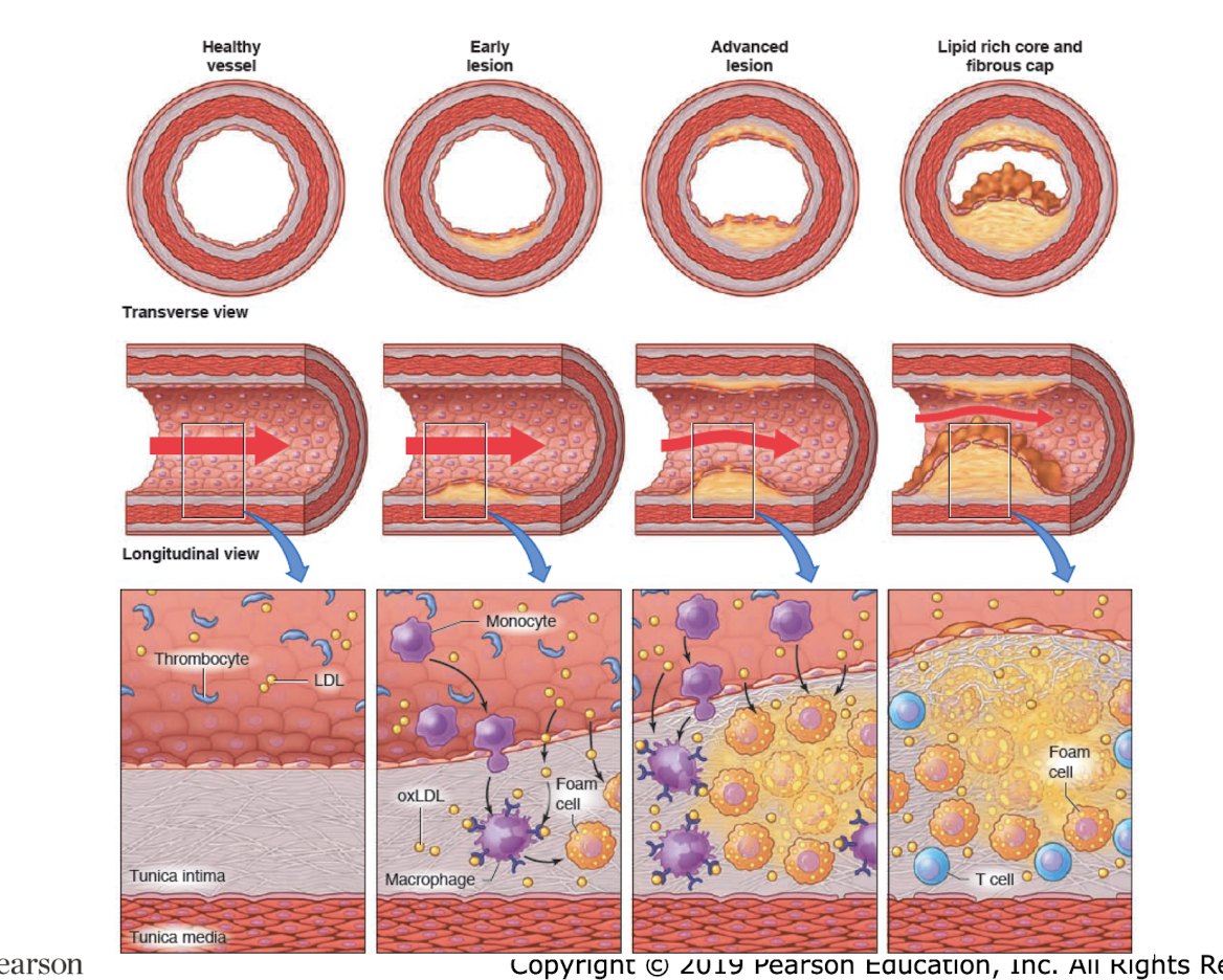 <p>cell and tissue features</p><ul><li><p>____</p><ul><li><p>narrowed coronary arterties</p></li><li><p>decreased blood flow</p></li><li><p>fracture in fibrous cap</p></li><li><p>superficial erosion of intima</p></li></ul></li></ul><p>Disruption of coronary blood flow</p><ul><li><p>imbalance among oxygen supply, demand, and consumption</p></li></ul><p>commonly mixed with arterialscleorsis (overall thickness of the artery)</p><ul><li><p>this is a type of arteriosclerosis </p></li></ul><p></p>