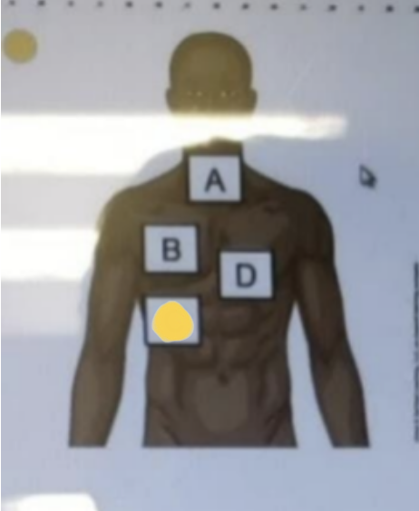 <p>78. a nurse is auscultating for crackles on a client who has pneumonia. Which of the</p><p class="p1">following anterior chest wall locations should the nurse auscultate?</p>