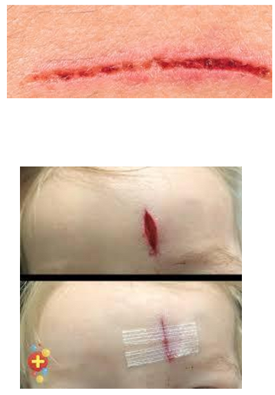 <p>What kind of lesion is this?</p>