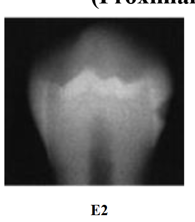<p>Radiolucency in the inner half of enamel</p>