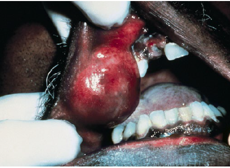 <p>canalicular adenoma</p>