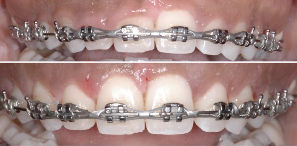 <p>Removes gum tissue at gum margin</p><p>To treat severe gingivitis </p>