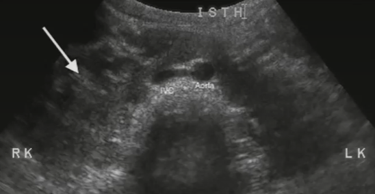 <p>Horseshoe kidney</p>