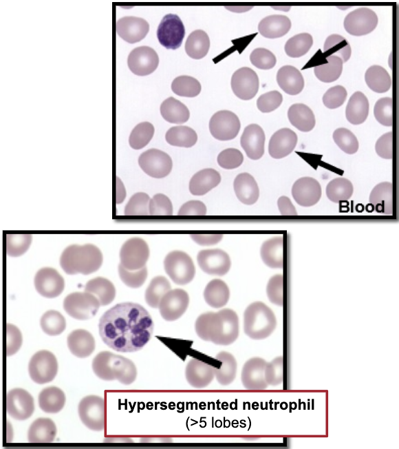 <p><strong>Smear Findings</strong></p><ul><li><p>H: Howell-Jolly Bodies</p></li><li><p>H: Hyper-segmented Neutrophils</p></li><li><p>O: Ovalocytes</p></li><li><p>T: Teardrops </p></li></ul><p><strong>Other Findings</strong></p><ul><li><p>giant platelets</p></li><li><p>schistocytes</p></li><li><p>pappenheimer</p></li><li><p>Basophilic stippling </p></li></ul><p><strong>MCV</strong></p><ul><li><p>>98.0</p></li></ul><p></p>