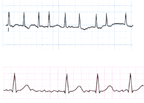 <ul><li><p class="Paragraph SCXW158423481 BCX8" style="text-align: left;"><span style="line-height: 20.85px;">Cause: Underlying heart disease, such as rheumatic heart disease, CAD, Cardiomyopathy, HF, Pericarditis </span></p></li></ul><ul><li><p class="Paragraph SCXW158423481 BCX8" style="text-align: left;"><span style="line-height: 20.85px;">Often acutely caused by: Thyrotoxicosis, Alcohol intoxication, Caffeine use, Electrolyte disturbance, Cardiac surgery, Hypertension </span></p></li></ul><ul><li><p class="Paragraph SCXW158423481 BCX8" style="text-align: left;"><span style="line-height: 20.85px;">Tx: </span></p></li></ul><ul><li><p class="Paragraph SCXW158423481 BCX8" style="text-align: left;"><span style="line-height: 20.85px;">Treatment Goals: Decrease ventricular response, Prevent embolic stroke </span></p></li></ul><ul><li><p class="Paragraph SCXW158423481 BCX8" style="text-align: left;"><span style="line-height: 20.85px;">Drugs for rate control: digoxin, B-adrenergic blockers, calcium channel blockers </span></p></li></ul><ul><li><p class="Paragraph SCXW158423481 BCX8" style="text-align: left;"><span style="line-height: 20.85px;">Long-term anticoagulation: </span></p></li></ul><ul><li><p class="Paragraph SCXW158423481 BCX8" style="text-align: left;"><span style="line-height: 20.85px;">For some patients, conversion to sinus rhythm may be considered </span></p></li></ul><ul><li><p class="Paragraph SCXW158423481 BCX8" style="text-align: left;"><span style="line-height: 20.85px;">Antidysrhythmic drugs used for conversion: Amiodarone </span></p></li></ul><ul><li><p class="Paragraph SCXW158423481 BCX8" style="text-align: left;"><span style="line-height: 20.85px;">Cardioversion may be used to convert atrial fibrillation to normal sinus rhythm </span></p></li></ul><ul><li><p class="Paragraph SCXW158423481 BCX8" style="text-align: left;"><span style="line-height: 20.85px;">Other treatment: Radiofrequency catheter ablation, Maze procedure, Modifications to the Maze procedure, Use of cold (cryoablation), Use of heat (high-intensity ultrasound) </span></p></li></ul><p></p>