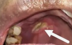 <p>Destructive nasal/sinus/palatal mass with necrotic black tissue.</p><p>Biopsy for non healing ulcer </p><p>Systemic antifungal med (amphotericin-ketoconazole, itraconazole)</p>