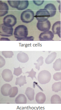 <p>Located on both sides of the lipid bi-layer inserted between the choline and amino phospholipids</p><p>Comprises 25% of the RBC membrane lipid</p><p>Continual exchange with plasma cholesterol</p><p>Accumulation of cholesterol will result in the formation of <strong>target cells </strong>and may cause membrane damage</p><p><strong>Acanthocytes</strong> have also been associated with an excess accumulation of membrane cholesterol in certain disorders</p><ul><li><p>Liver disease</p></li><li><p>Inherited lipid disorders such as abetalipoproteinemia and lecithin-cholesterol acyltransferase (LCAT) deficiency</p></li></ul><p></p>