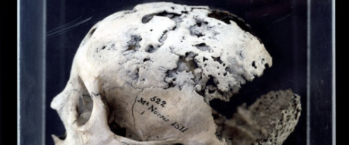 <p><span style="background-color: transparent;">= STI caused by bacterium Treponema pallidum (TP)</span></p><ul><li><p><span style="background-color: transparent;">Pitting or porous lesions on the skull</span></p></li><li><p><span style="background-color: transparent;">Irregular new bone formation</span></p></li><li><p><span style="background-color: transparent;">Destructive lesions that alter normal bone surface</span></p></li><li><p><span style="background-color: transparent;">Targets bones that are rich with blood supply</span></p></li></ul><p></p>