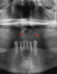 <p>How is this lesion described in terms of internal structure?</p>
