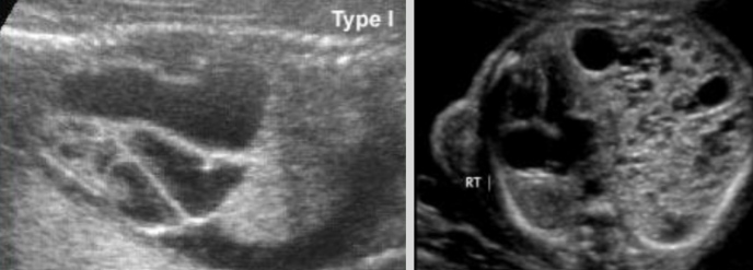 <ul><li><p><span style="background-color: transparent;">Most common, 70% of cases </span></p></li><li><p><span style="background-color: transparent;">Macrocystic, nonvascular cystic mass in fetal lung</span></p></li></ul><p></p>