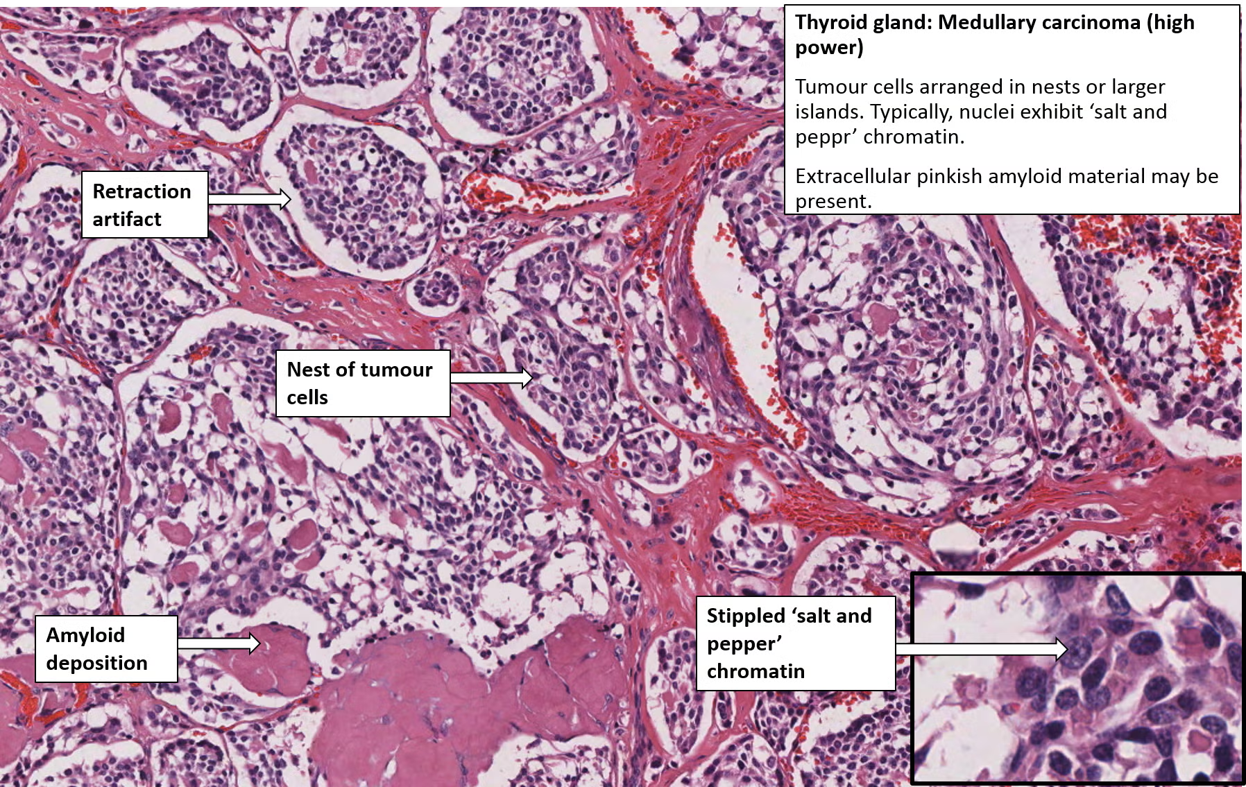 <p>medullary thyroid cancer</p>