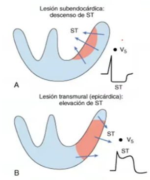 <p><span style="background-color: transparent;"><strong>Lesión subendocardica</strong></span></p>