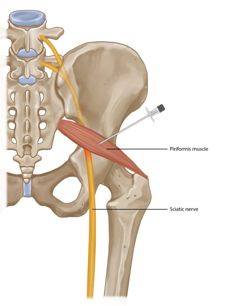 <p>Anterior surface of sacrum between anterior sacral foramina</p>