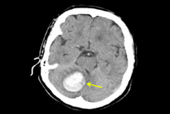 <p>hemorrhage within the cerebellum</p>