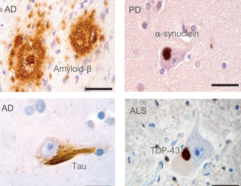 <ul><li><p>there are over 30 human pathologies associated to protein aggregation</p><ul><li><p>e.g. Alzheimer’s (AD), Amyotrophic lateral sclerosis (ALS), Huntington, Parkinson’s, prion diseases</p></li></ul></li><li><p>these diseases are characterized by the presence of amyloid protein aggregates in the affected tissues</p><ul><li><p>specific proteins are found at unusually high concentrations inside the aggregates compared to their normal levels.</p></li></ul></li><li><p>in most cases, the cause of the disease is unclear and no cure exists</p></li><li><p>there are many types of amyloid diseases</p></li></ul><p></p>