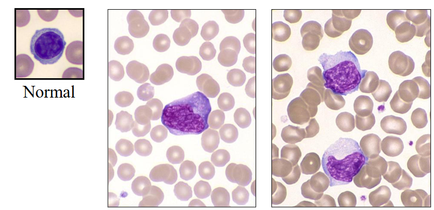 <p>- large activated lymphocytes with irregularly shaped nuclei; abundant flowing basophilic cytoplasm with a dark-staining periphery</p>