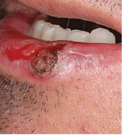 <p>CASE: You are counseling patients about site-specific oral cancer risks. Which extrinsic exposure is especially relevant to vermilion lip cancer, which infectious risk is especially relevant to oropharyngeal cancer, and which two classic exposures are major oral-cavity risks?</p>