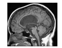 <p>A. Cerebral aqueduct</p>