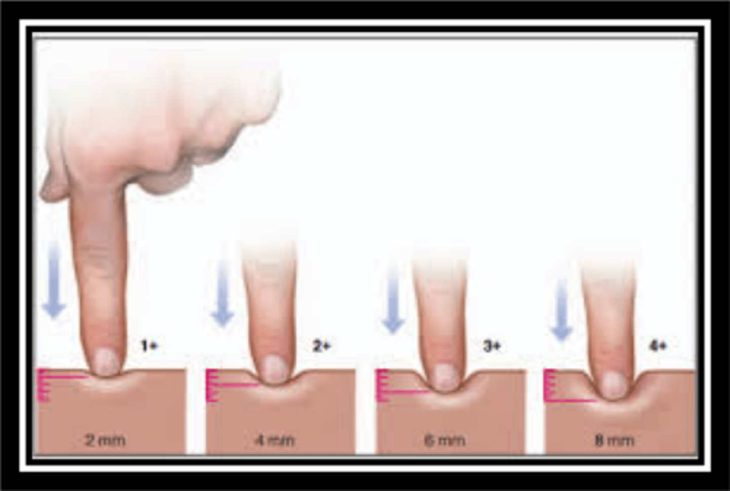 <p>• 1+ Mild pitting, slight indentation, no perceptible swelling of the leg</p><p>• 2+ Moderate pitting, indentation, subsides rapidly</p><p>• 3+ Deep pitting, indentation remains for a short time, leg looks swollen</p><p>• 4+ Very deep pitting, indentation lasts a long time, leg is very swollen</p>