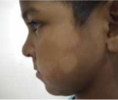 <p>Mencione características de las manchas hipocrómicas iniciales en la Lepra </p>