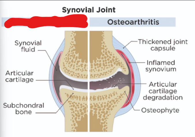 <p>what is it<strong> (Osteoarthritis)</strong></p>