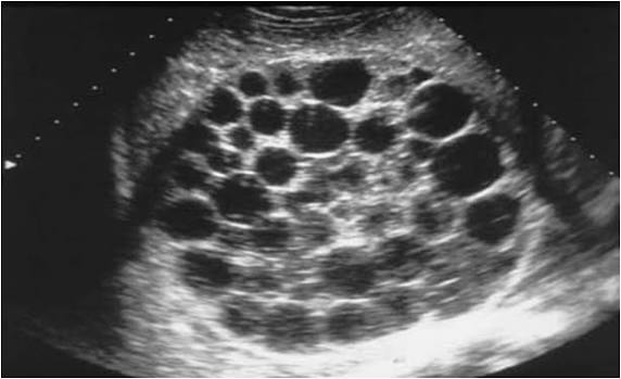 <p>simple cyst </p><p>complex cyst </p><ul><li><p>daughter cysts</p></li><li><p>honeycomb sign (septa) </p></li><li><p>mobile debris </p></li><li><p>water lilly sign </p></li></ul><p></p>