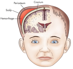 <p>Normal: Fontanels soft and flat, suture lines, caput succedaneum, molding </p><p>Abnormal: Cephalohematoma, bulging or sunken fontanels</p>