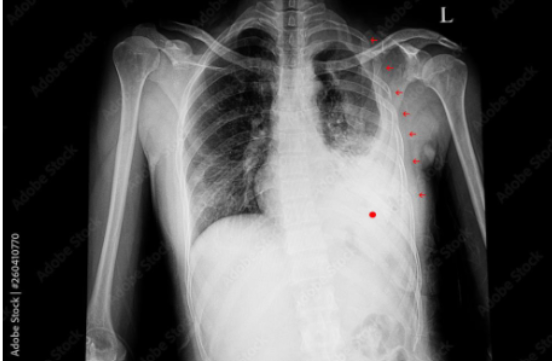 <p>ICG: is this a pulmonary contusion, pneomothorax, or hemothorax</p>
