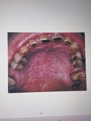 <p>Benign lesion associated with pipe/cigar smoking, or cigarette smoking. Initially appears: erythema</p><p>Keratinization occurs causing opacity. </p><p>Red raised areas occur at the openings of ducts of inflamed minor salivary glands.</p>
