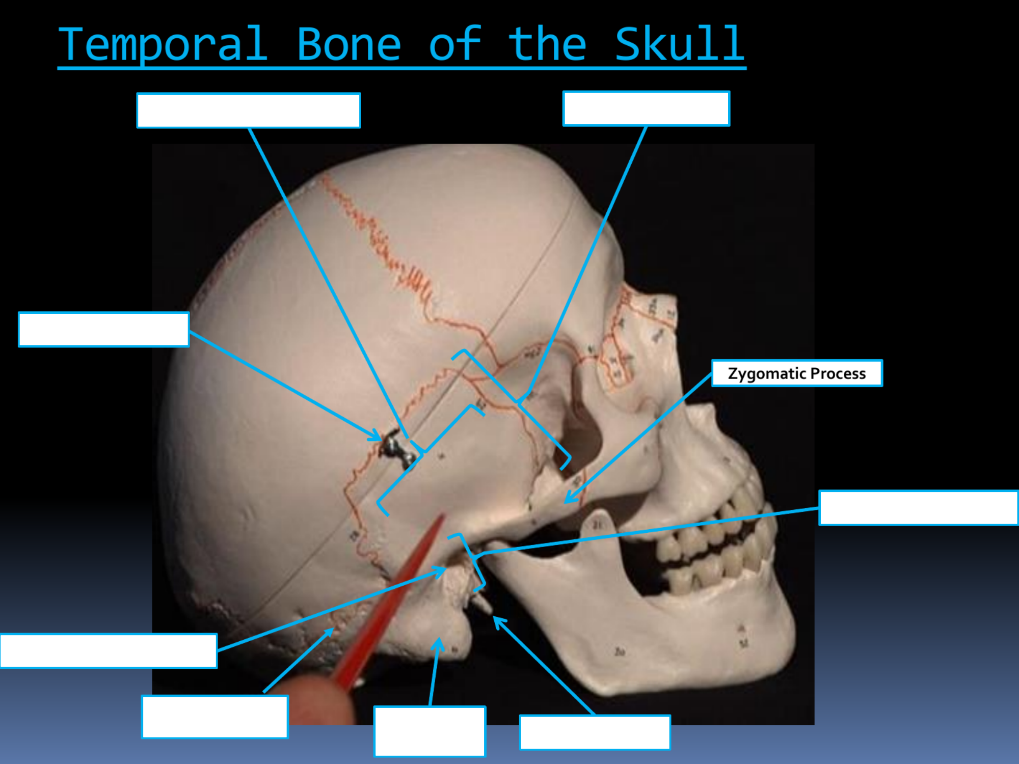<p>Zygomatic Process</p>