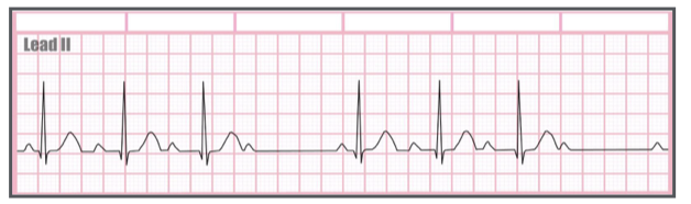 <p>Identify the above waveform:</p><p>a. First degree heart block</p><p>b. Third degree heart block</p><p>c. normal sinus rhythm</p><p>d. Second degree heart block type I</p>