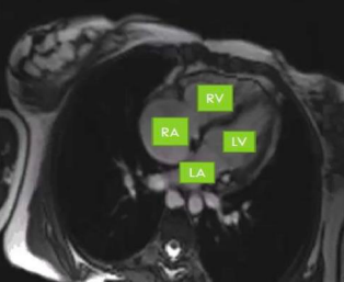 <ul><li><p>RA</p></li><li><p>RV</p></li><li><p>LA </p></li><li><p>LV </p></li><li><p>Mitral valve </p></li><li><p>Tricuspid valve </p></li></ul><p></p>