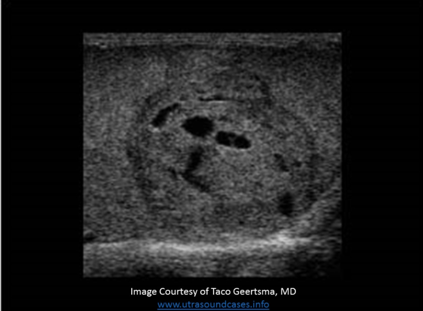 <p>The mass on the image is most likely a non-seminomatous germ cell tumor because of the characteristic heterogeneous texture with areas of cystic degeneration</p>