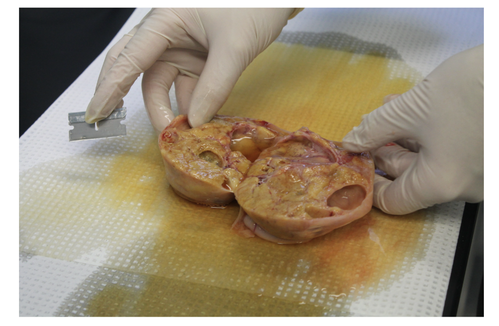<p>In 2-3 sentences, provide an answer for the following case study: A cow is diagnosed as having cystic ovarian structures. One large ovary was removed and it was determined that the cystic structures within it immuno-stained strongly for inhibin and anti-Mullerian hormone (AMH).&nbsp;&nbsp;What does detection of inhibin and AMH indicate about the type of cystic structures present? What are the roles of inhibin and AMH?4</p>