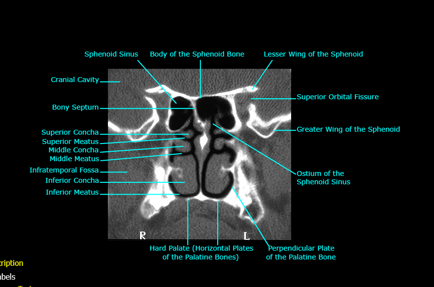 <ol start="7"><li><p>Body of the Sphenoid bone</p></li><li><p>Sphenoid sinus</p></li><li><p>Cranial Cavity</p></li><li><p>Bony Septum</p></li></ol><p></p>