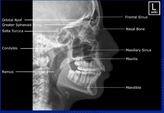 <p>lat img of R + L supimp facial bones</p><p>frontal sinus</p><p>nasal bone</p><p>maxilla</p><p>mandible</p><p>orbital roof</p><p>greater sphenoid</p><p>sella turcica</p><p>condyles</p><p>ramus</p>