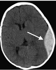 <p><span style="font-family: "Wingdings 3";">u</span><span style="font-family: "Trebuchet MS";">= an accumulation of blood between the skull and the dural membrane.</span></p><p><span style="font-family: "Wingdings 3";">u</span><span style="font-family: "Trebuchet MS";">Seen in 2-4% of TBI</span></p><p><span style="font-family: "Wingdings 3";">u</span><span style="font-family: "Trebuchet MS";">Between dura and skull</span></p><p><span style="font-family: "Wingdings 3";">u</span><span style="font-family: "Trebuchet MS";">Most commonly middle meningeal artery</span></p><p><span style="font-family: "Wingdings 3";">u</span><span style="font-family: "Trebuchet MS";">Overall mortality of 10%</span></p><ul><li><p><span style="font-family: "Trebuchet MS";"><10% when treated early</span></p></li></ul><p></p>