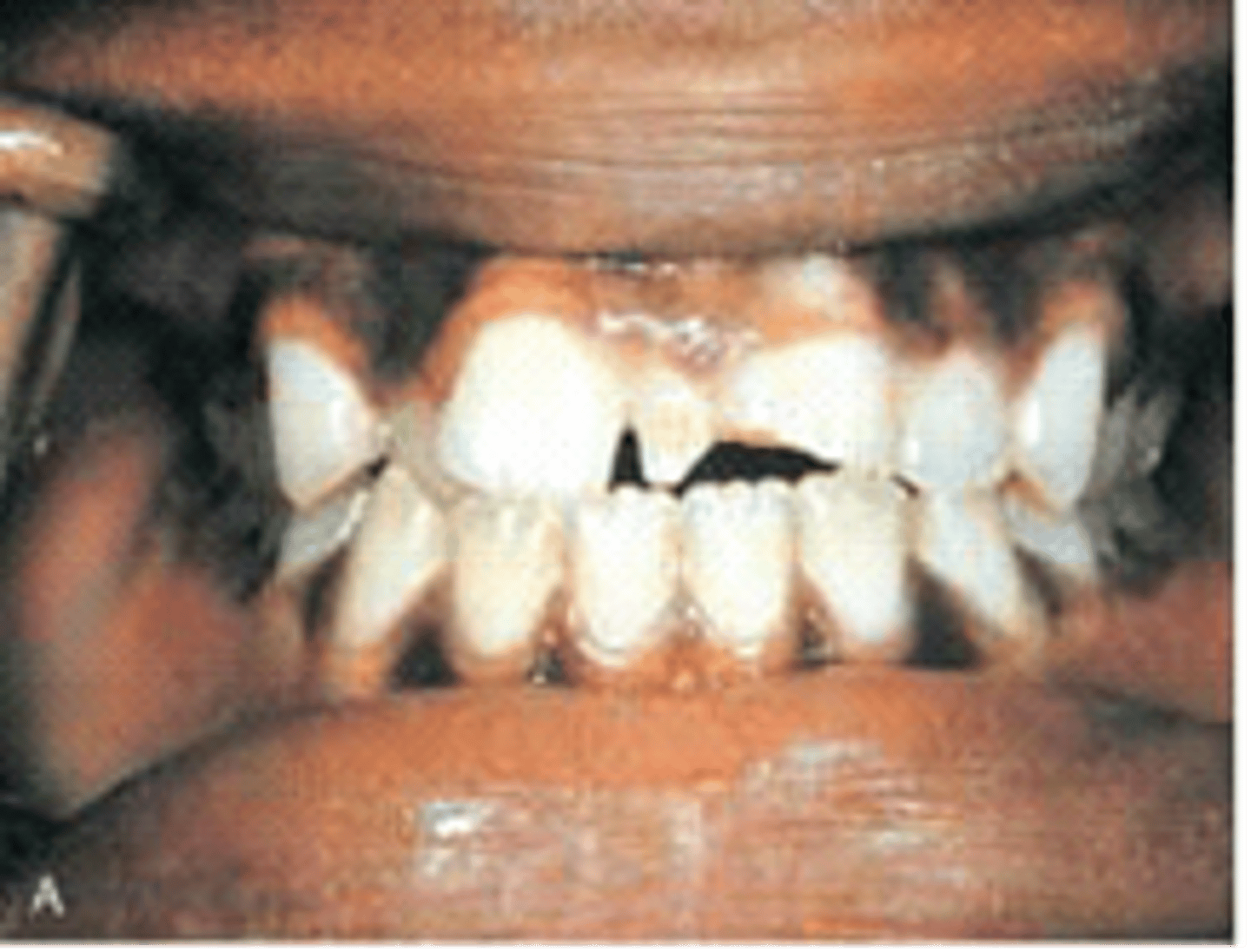 <p><br>Supernumerary tooth between two permanent maxillary central incisors</p><p><br></p><p>The supernumerary tooth seen between teeth #8 & 9 is called?</p>