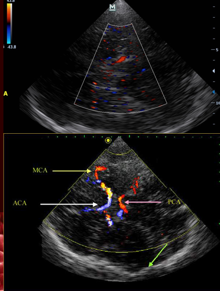 <p>measure velocities </p><p>MCA > ACA > PCA </p>