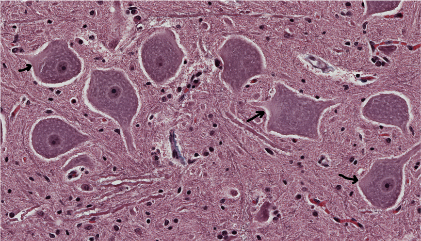 <p><span style="font-family: "Calibri Light";">Three clear-staining areas in the cytoplasm of some of these large motor neurons are indicated with arrowed lines. <br><br>1. What are they called?<br>2. Why are they clear-staining?</span></p>