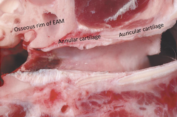 <p>The external ear consists of the <strong>auricle</strong>/pinna and the <strong>external acoustic meatus</strong>(ear canal), and it terminates at the tympanic membrane. Responses to injury include:</p><ul><li><p>Inflammation</p></li><li><p>Epithelial and adnexal hyperplasia</p></li><li><p>Fibrosis</p></li><li><p>Osseous metaplasia/heterotopic ossification</p></li><li><p>Neoplasia</p></li></ul><p></p>