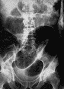 <p> Que signo radiologico observa </p>